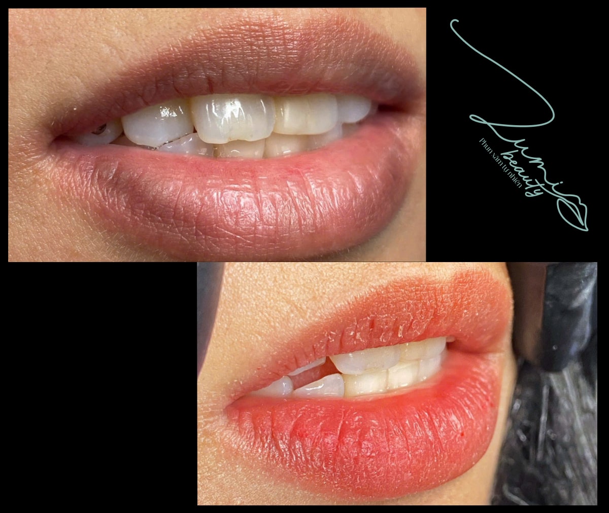 Môi sau khi phun và trong quá trình bong