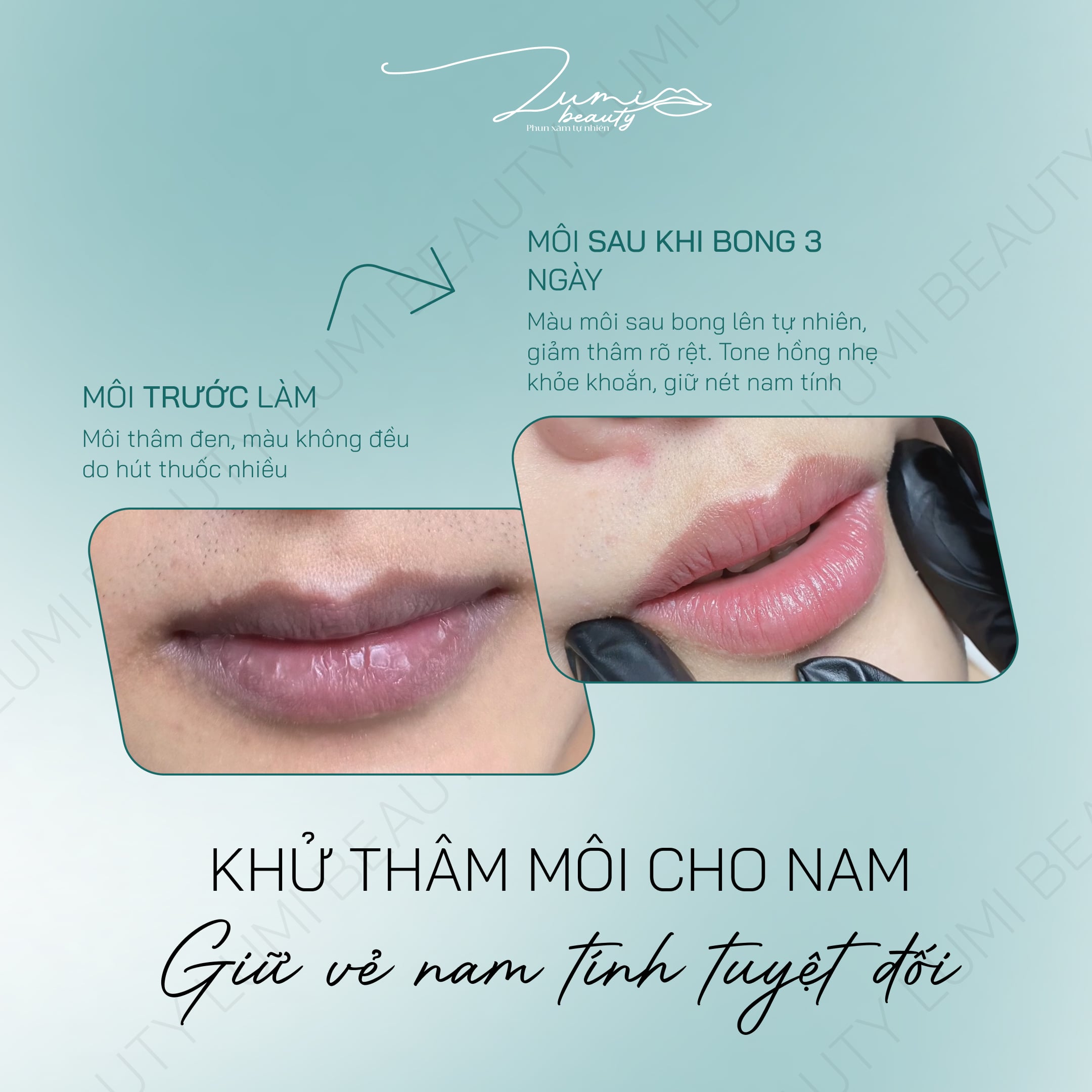 Khử thâm môi cho nam tại Đà Nẵng