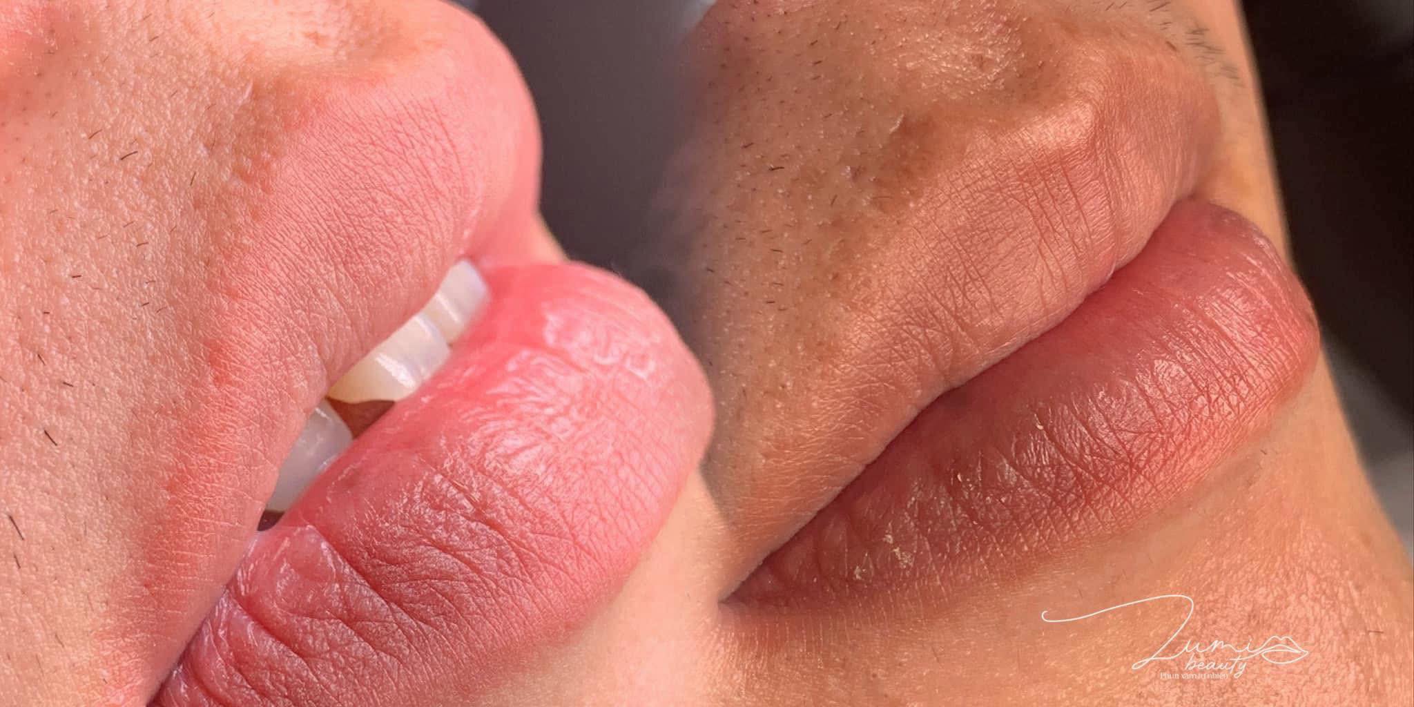 Khách nam – không sưng, không đỏ