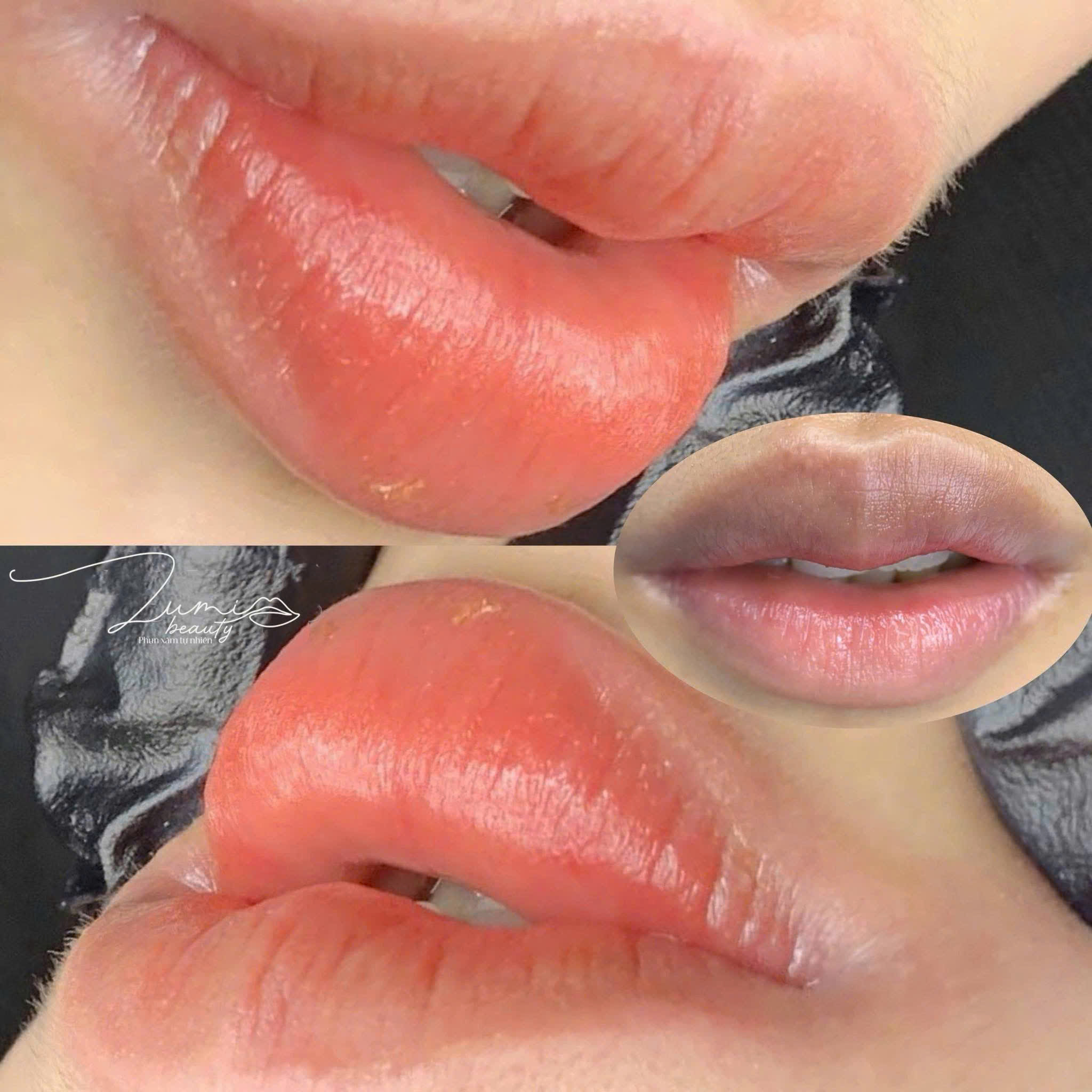 Kết quả khử thâm môi trước và sau