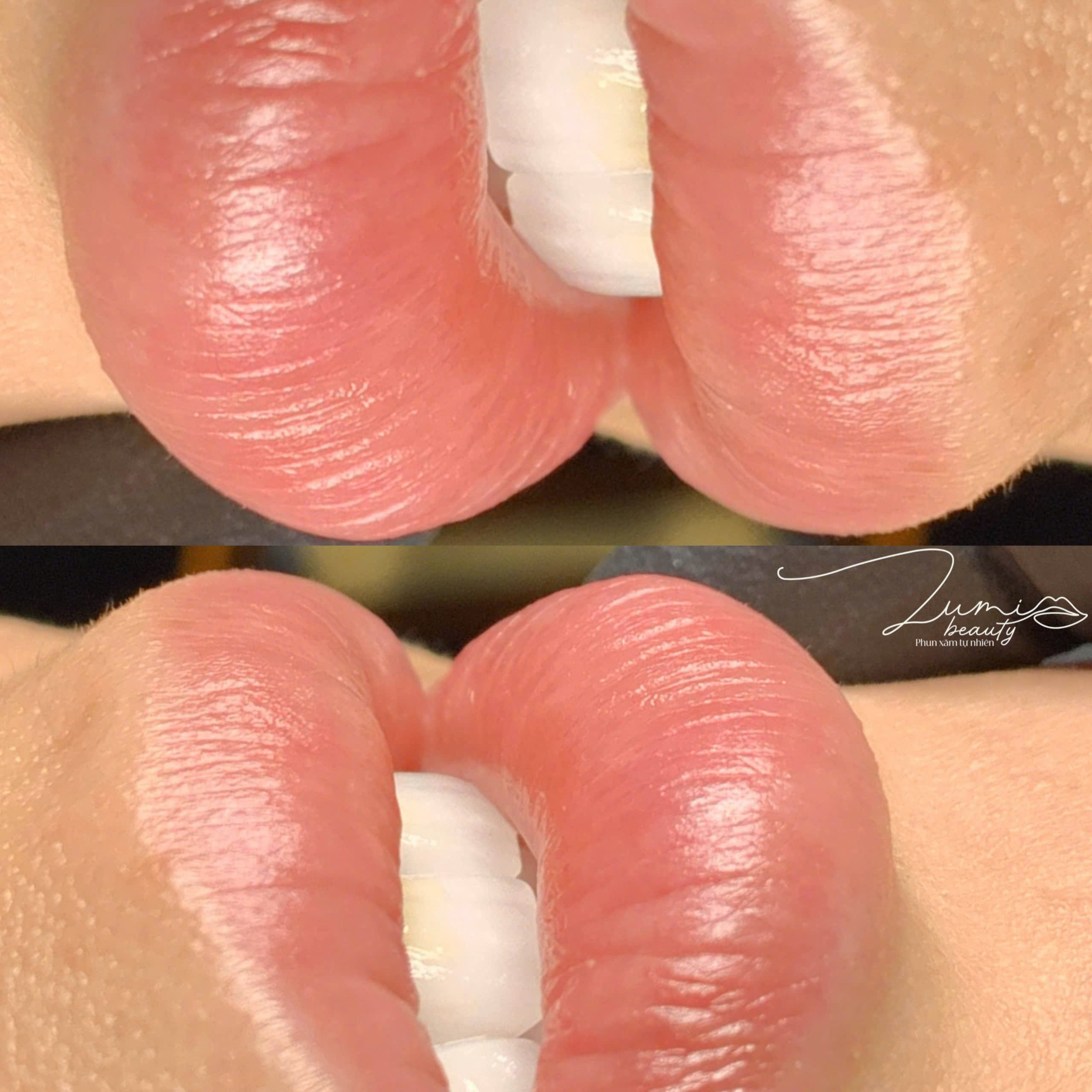 Kết quả khử thâm môi trước và sau