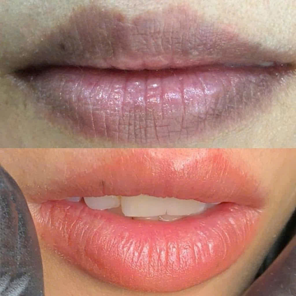 Kết quả khử thâm môi trước và sau