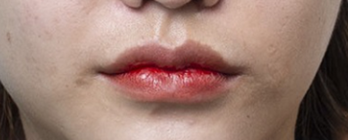 Môi lệch, viền môi không cân xứng